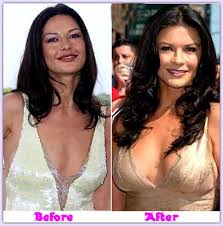 Catherine Zeta Jones Plastic Surgery Before And After Face Lift, Breast Implants 2