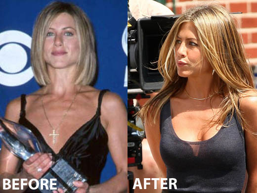 Jennifer Aniston Breast Implants Plastic Surgery Before and After Boobs Job