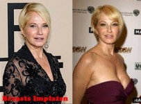 Ellen Barkin Plastic Surgery Before And After Pictures